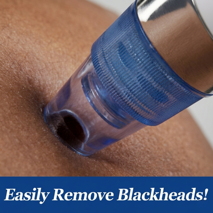 DermaSuction™ Blackhead Vacuum & Deep Pore Cleanser