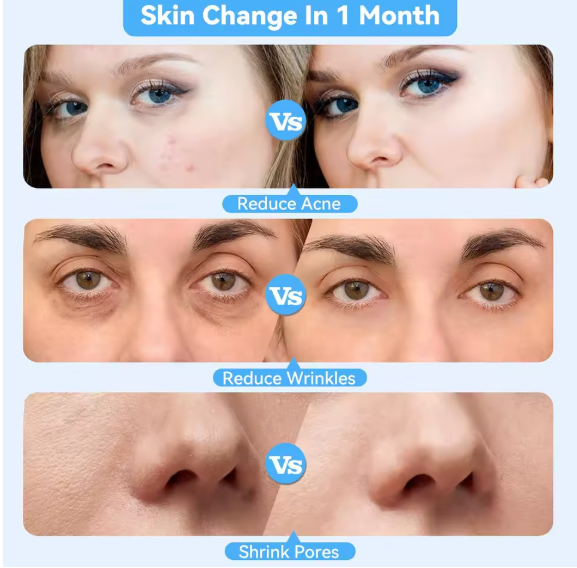 DermaSuction™ Blackhead Vacuum & Deep Pore Cleanser